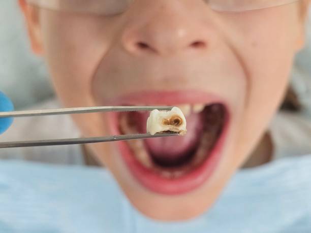 Best Same-Day Emergency Dentist in Pen Argyl, PA